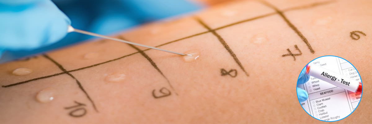 Understanding Allergies and the Essential Role of Allergy Testing